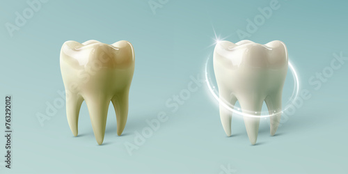 Comparison of clean and dirty tooth before and after whitening treatment, isolate on blue background. Teeth whitening concept.