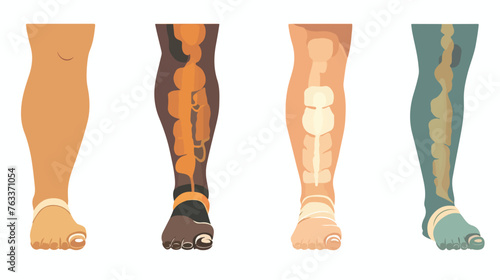 Lymphedema disease concept. Stages of swelling of fem photo