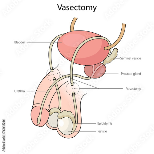 vasectomy on the male reproductive system, highlighting key anatomical features structure diagram hand drawn schematic vector illustration. Medical science educational illustration photo