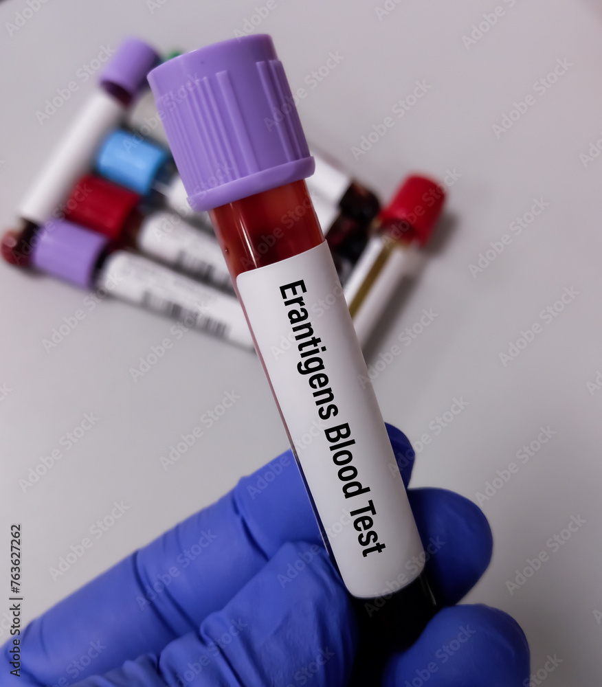Fototapeta premium Technician hold blood sample for Er Blood Group System.