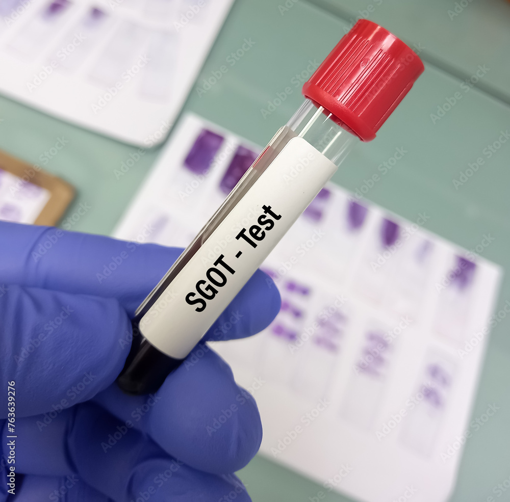 Blood sample for AST(aspartate aminotransferase) or SGOT test to help diagnose liver damage or disease. liver function test.