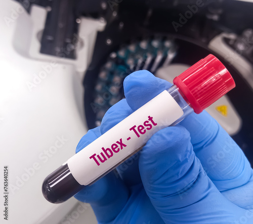 Blood sample for Tubex test, Triple antigen test, diagnosis of salmonellosis, Febrile antigen test. photo