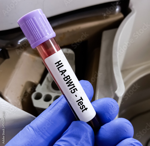 Test tube with blood sample for HLA-BW15 (Human Leukocyte Antigen-BW15) test. photo