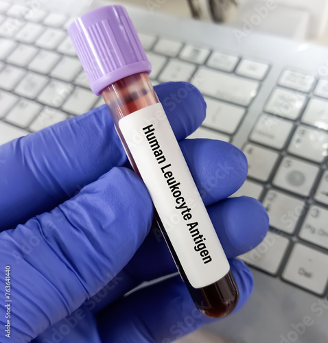 Test tube with blood sample for HLA (Human Leukocyte Antigen) typing test. photo