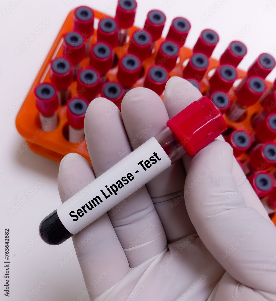 Biochemist holds blood sample for Serum Lipase test, used to diagnose