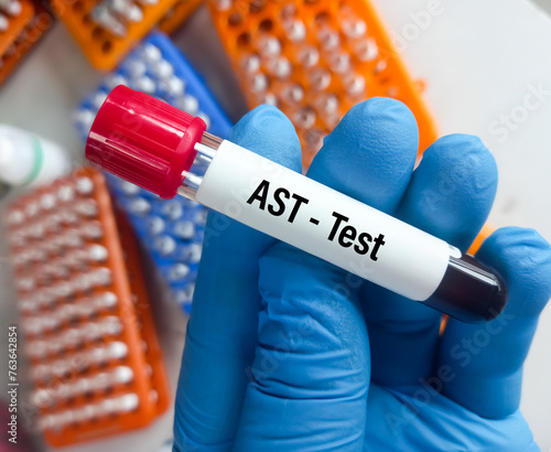 Blood sample for AST(aspartate aminotransferase) or SGOT test to help diagnose liver damage or disease. liver function test. photo