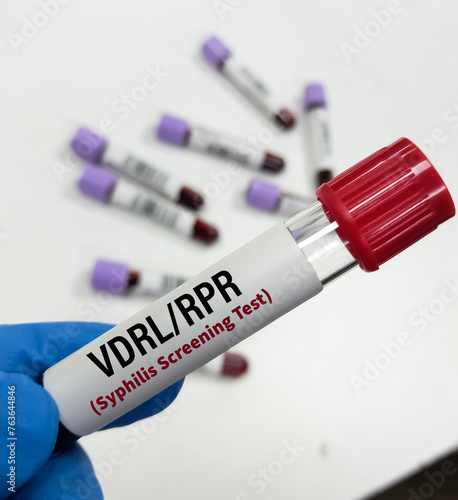 Blood sample for VDRL or RPR test, Syphilis screening test. To diagnosis Syphilis and Gonorrhea, STD disease.