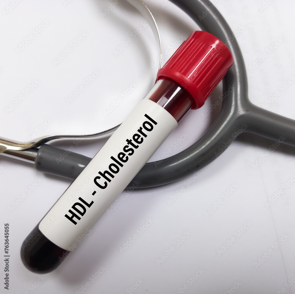 Blood sample for HDL cholesterol test, (Fasting Lipid Profile), total