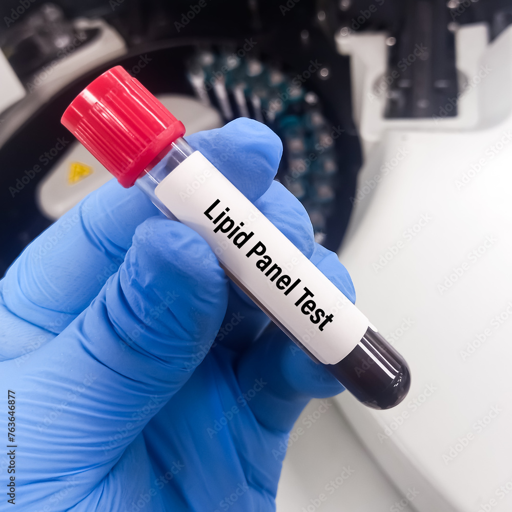 Blood sample for Lipid panel test, Lipid Profile test, (total