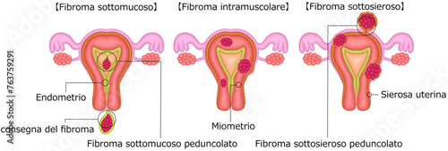 子宮筋腫　分類　イラスト　イタリア語 photo