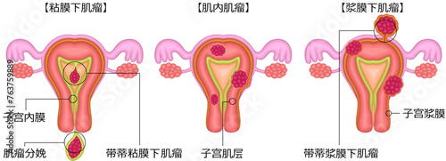 子宮筋腫　分類　イラスト　中国語