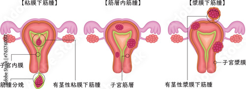 子宮筋腫　分類　イラスト　日本語