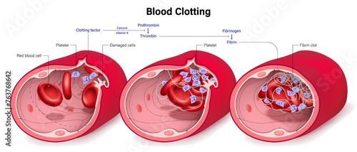 Blood clotting process. Damaged blood vessel, Formation of platelet plug and Fibrin clot.