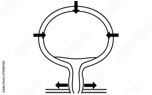 Medical illustration of the normal bladder, how it urinates, and how it urinates