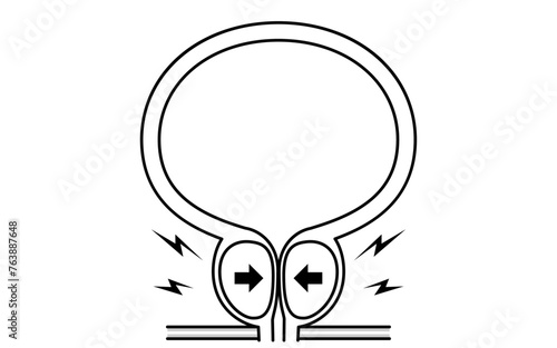 Medical illustration of benign prostatic hyperplasia, enlarged prostate