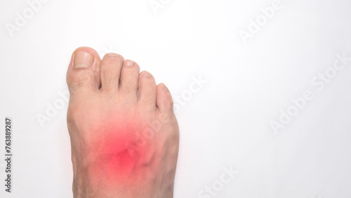 Fotografi Close up of the instep of a person right foot with a red mark representing pain