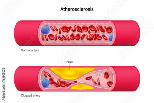 Normal artery and Clogged artery vector. Cardiovascular Disease. Coronary artery syndrome. Cholesterol in blood vessels. photo