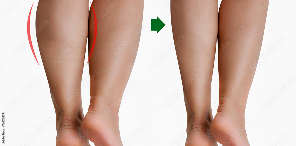 Comparison woman's legs before and after reduce size by botox or liposuction. - obrazy, fototapety, plakaty 