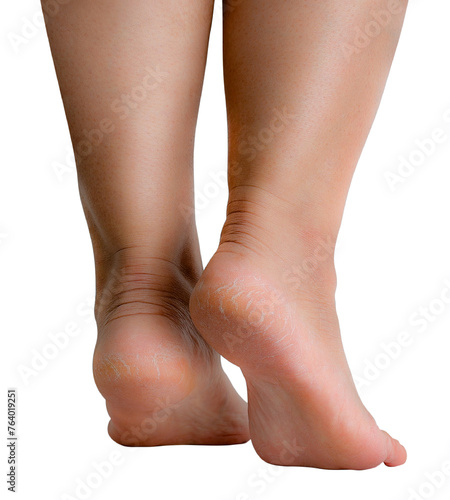 Woman's barefoot with cracks dry skin, using for medical treatment with moisturizers for skin peeling on heel isolated on white. 
