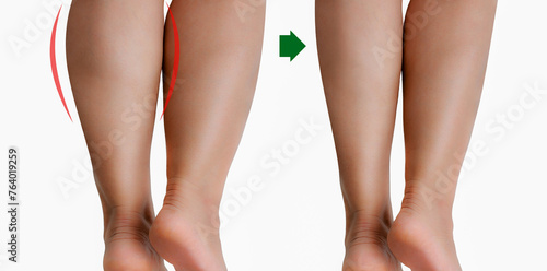 Comparison woman's legs before and after reduce size by botox or liposuction. photo