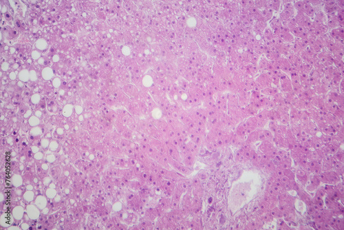 Hepatic steatosis, light micrograph photo