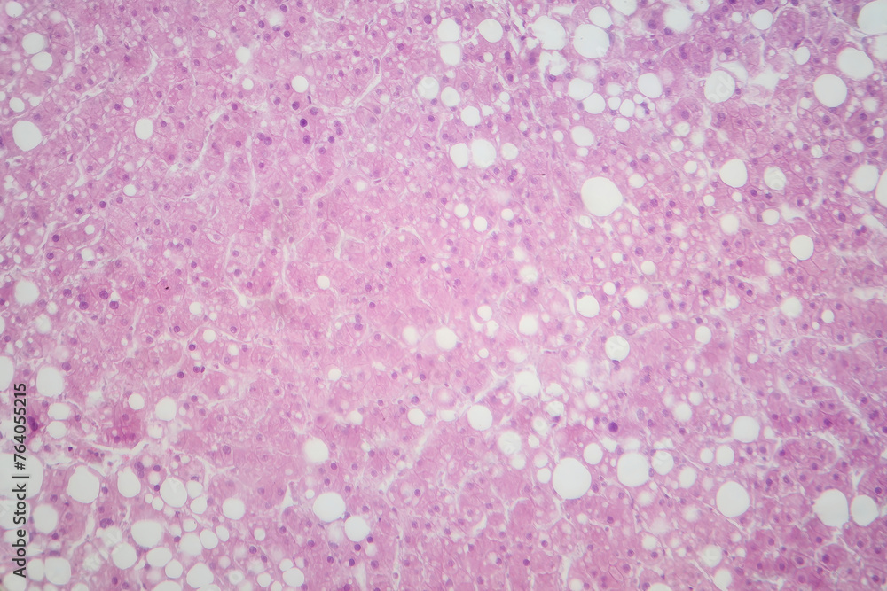 Hepatic steatosis, light micrograph Hepatic steatosis, light micrograph