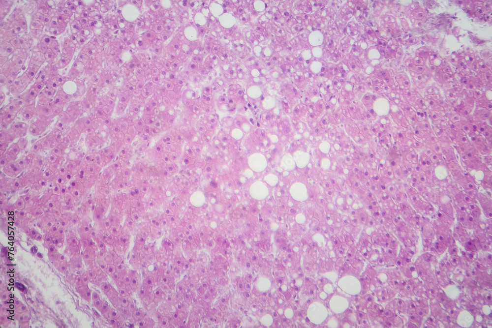 Hepatic steatosis, light micrograph