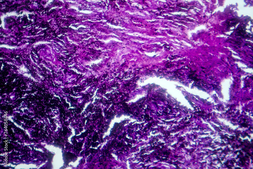 Photomicrograph of lung tissue with silicosis pathology under a microscope, revealing silica particle accumulation in alveoli and fibrosis.