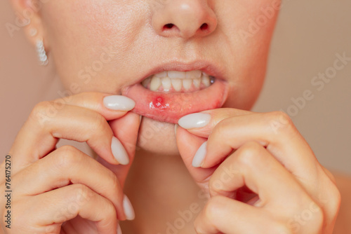 A young woman suffering from stomatitis. She pulls back her lower lip with both hands, shows an ulcer of stomatitis in the acute stage on the mucous membrane of the mouth.
