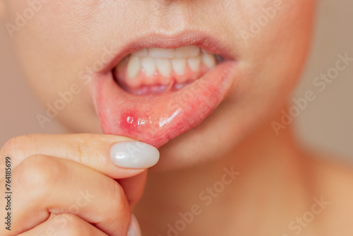 a close-up photo of a young woman showing an ulcer of stomatitis in the acute stage on the mucous membrane of the mouth.  photo