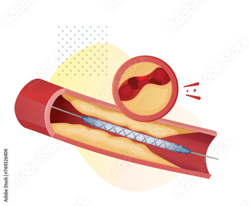 Atherosclerosis Stages - Cholesterol Plaque Buildup - Stock Illustration