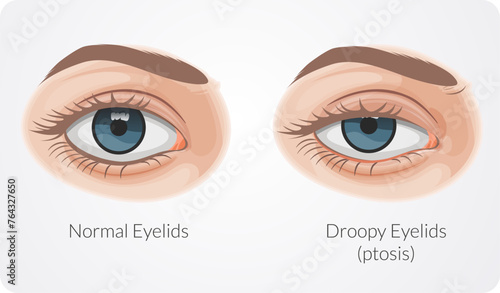 Ptosis drooping upper eyelid - Stock Illustration