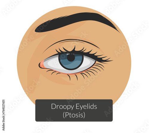 Ptosis drooping upper eyelid - Stock Illustration