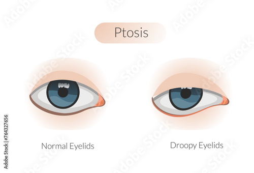 Ptosis drooping upper eyelid - Stock Illustration