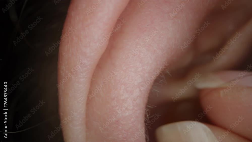 A woman removes silicone earplugs from her ear, macro, slow motion. Concept of Hearing Restoration. A woman removes silicone earplugs from her ear, macro, slow motion. Concept of Hearing Restoration.