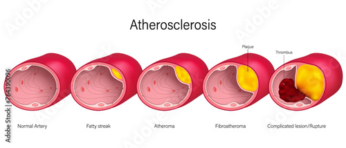 Atherosclerosis vector. Cardiovascular Disease. Coronary artery syndrome. Clogged artery. Causes of myocardial ischemia. 