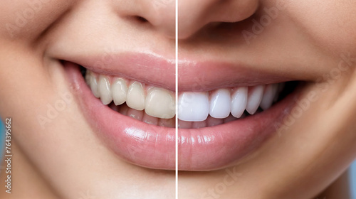 Girl before and after teeth whitening, closeup. Smile with yellow and white teeth. Banner design