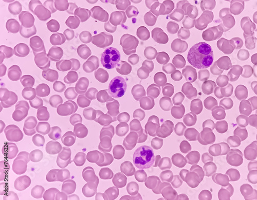 Photomicrograph of hematological slide showing RBC, WBC (Neutrophils and Eosinophil) and platelet. Normal hemogram. CBC.