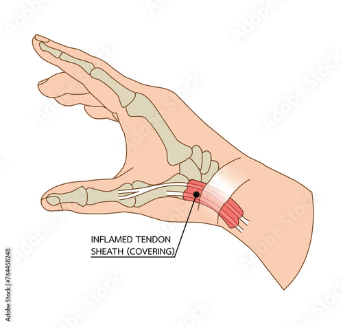 Tendon thumb De-quervain's disease, an inflamed tendon, sheath (covering), illustration on white background