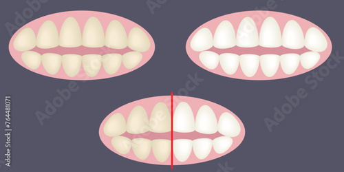 Teeth whitening. Before and after. Dental Care. Design elements. Vector illustration. Isolated on a blue background