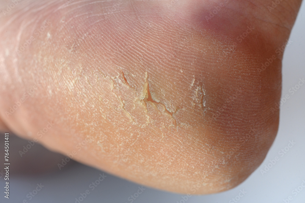 Close-up of a cracked heel. Strong crack and dry scaly skin on the foot.The concept of foot care, pedicure Close-up of a cracked heel. Strong crack and dry scaly skin on the foot.The concept of foot care, pedicure
