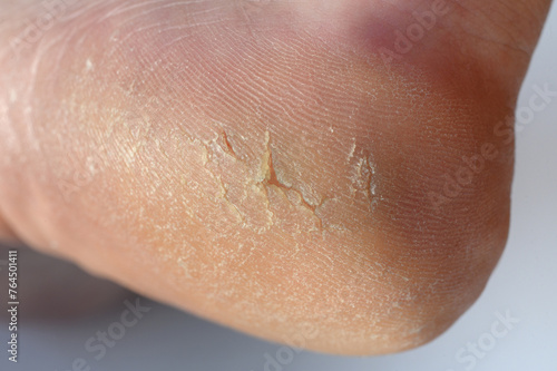 Close-up of a cracked heel. Strong crack and dry scaly skin on the foot.The concept of foot care, pedicure