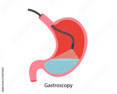 Gastroscopy procedure. Research of a stomach gastroscope. Disease of the stomach and duodenum. Close-up vector image of the stomach