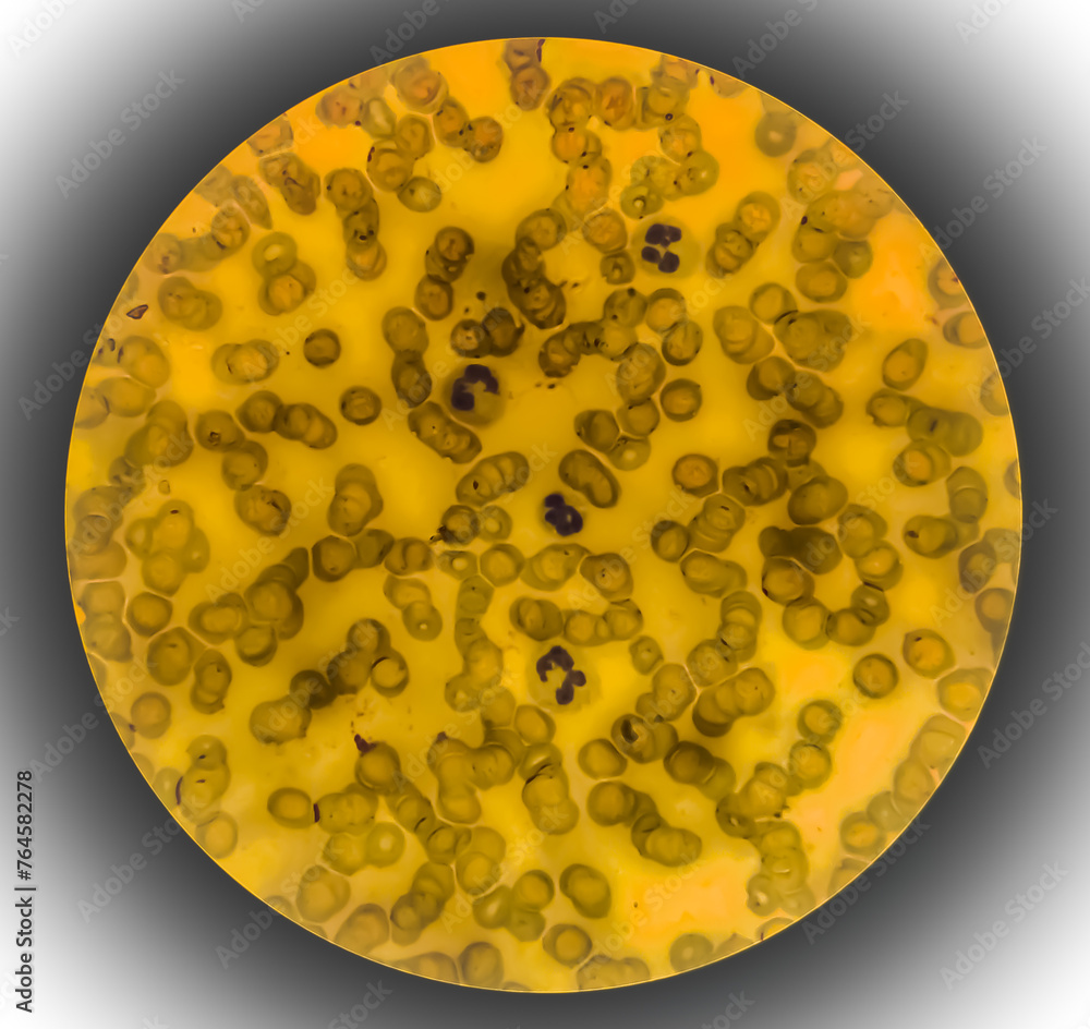 Acute thrombocytopenia and leukocytopenia with normal RBC analysed by ...