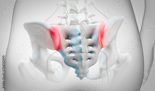 Inflammation of sacroiliac joints, illustration photo