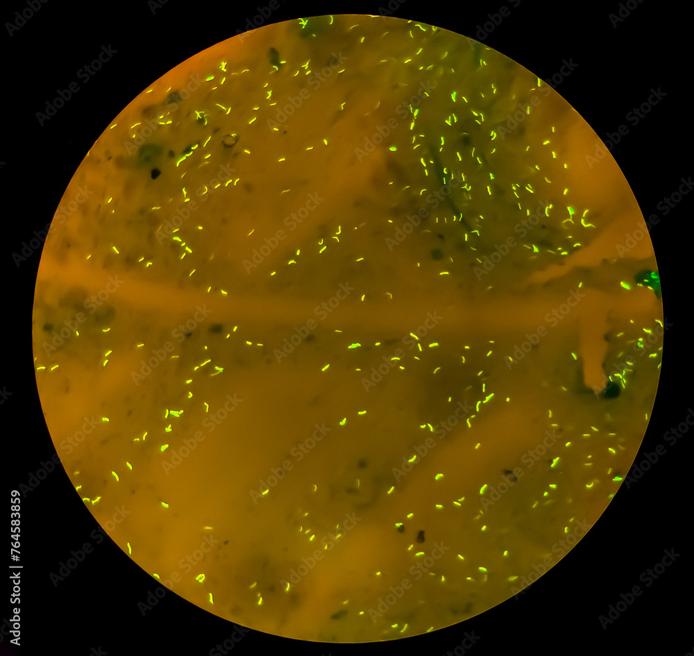 Sputum smear microscopic examination show Microbacterium Tuberculosis