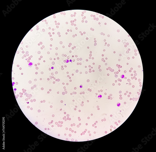 Photomicrograph of hematological slide showing severe anemia. Hemolytic anemia, iron deficiency anemia. photo