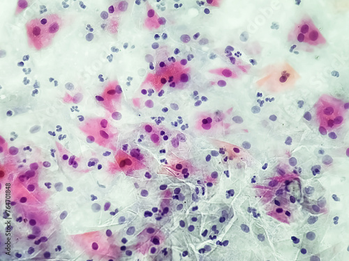 Gardnerella vaginalis infection pap smear under microscopy.