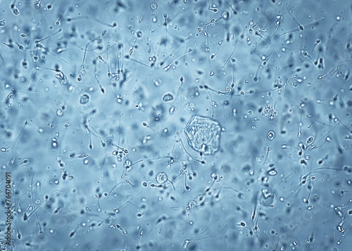 Asthenozoospermia, a common cause of human male infertility characterized by reduced sperm motility