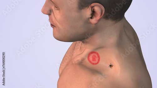 Lyme disease with tick on shoulder neck medical concept photo